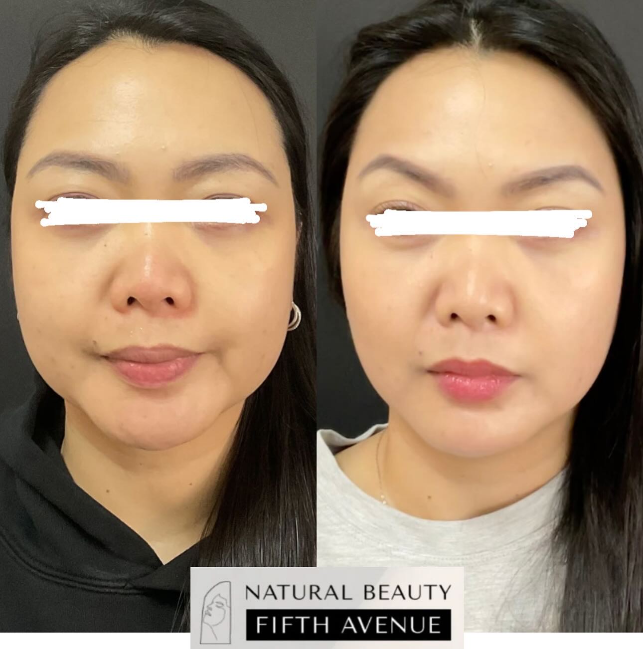 Before and after dermal fillers treatment showing improved facial volume and definition